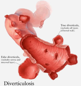 Illustration of Diverticular Disease