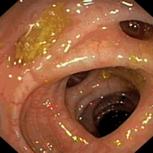 Photo of Diverticular Disease