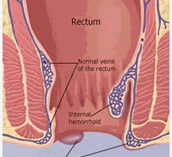 Illustration showing normal veins and Hemorrhoids