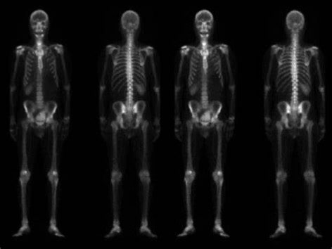 Photo of Nuclear Medicine scan of skeleton