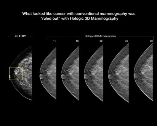Photo of Stereotactic Breast Biopsy Imaging