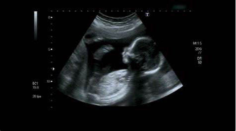 Photo of a baby on an Ultrasound scan